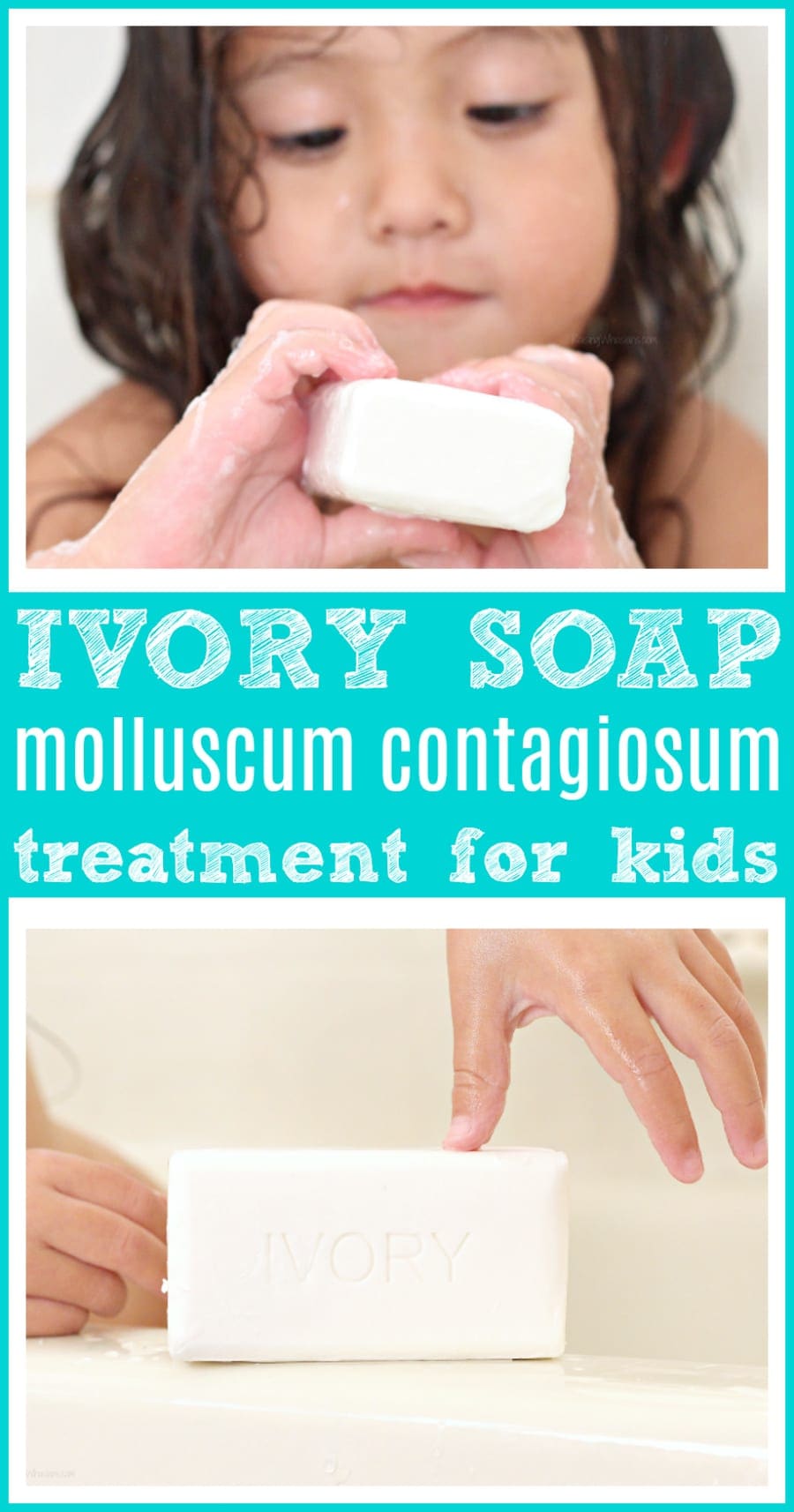 Ivory soap to treat molluscum contagiosum