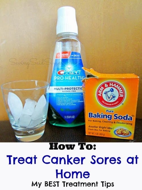 How To Treat Canker Sores At Home