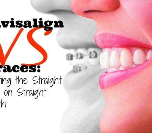 Invisalign versus braces